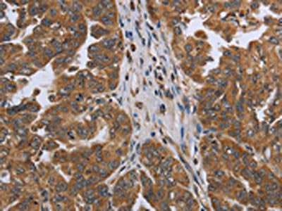 The image on the left is immunohistochemistry of paraffin-embedded Human ovarian cancer tissue using the antibody Antibody) at dilution 1/45, on the right is treated with synthetic peptide. (Original magnification: ×200)Rabbit anti-Human NDUFAF4 Polyclonal Antibody