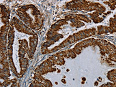 The image on the left is immunohistochemistry of paraffin-embedded Human esophagus cancer tissue using the antibody Antibody) at dilution 1/50, on the right is treated with fusion protein. (Original magnification: ×200)Rabbit anti-Human HSD17B2 Polyclonal Antibody