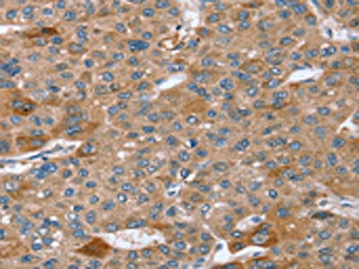 The image on the left is immunohistochemistry of paraffin-embedded Human liver cancer tissue using SPATA5L1 Antibody(SPATA5L1 Antibody) at dilution 1/20, on the right is treated with synthetic peptide. (Original magnification: ×200)Rabbit anti-Human SPATA5L1 Polyclonal Antibody