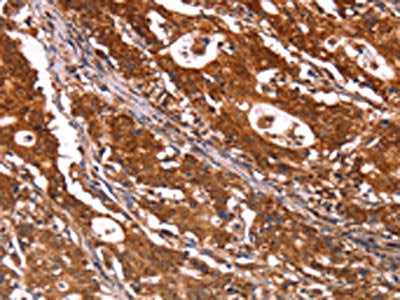 The image on the left is immunohistochemistry of paraffin-embedded Human gastric cancer tissue using ABI1 Antibody(ABI1 Antibody) at dilution 1/40, on the right is treated with synthetic peptide. (Original magnification: ×200)