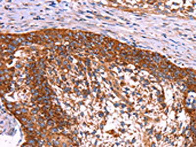 The image on the left is immunohistochemistry of paraffin-embedded Human cervical cancer tissue using the antibody Antibody) at dilution 1/40, on the right is treated with synthetic peptide. (Original magnification: ×200)