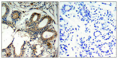 Immunohistochemical analysis of paraffin-embedded human breast carcinoma tissue using SHP-2(Ab-580) Antibody(left) or the same antibody preincubated with blocking peptide(right).Rabbit anti-Human PTPN11 Polyclonal Antibody