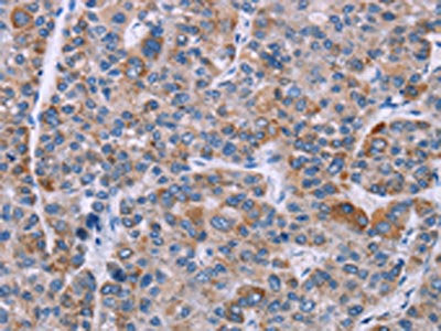 The image on the left is immunohistochemistry of paraffin-embedded Human liver cancer tissue using KRT14 Antibody(KRT14 Antibody) at dilution 1/20, on the right is treated with synthetic peptide. (Original magnification: ×200)