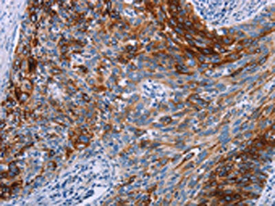 The image on the left is immunohistochemistry of paraffin-embedded Human cervical cancer tissue using the antibody Antibody) at dilution 1/20, on the right is treated with synthetic peptide. (Original magnification: ×200)