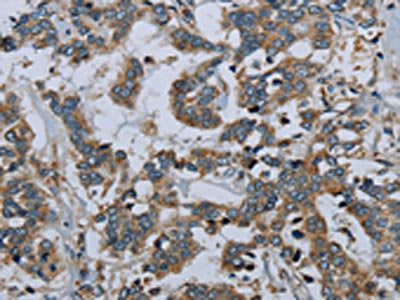 The image on the left is immunohistochemistry of paraffin-embedded Human liver cancer tissue using PCK2 Antibody(PCK2 Antibody) at dilution 1/60, on the right is treated with fusion protein. (Original magnification: ×200)Rabbit anti-Human PCK2 Polyclonal Antibody