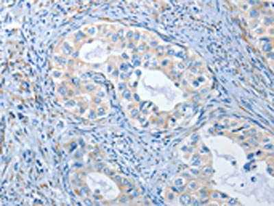 The image on the left is immunohistochemistry of paraffin-embedded Human cervical cancer tissue using PRKG2 Antibody(PRKG2 Antibody) at dilution 1/20, on the right is treated with synthetic peptide. (Original magnification: ×200)Rabbit anti-Human PRKG2 Polyclonal Antibody