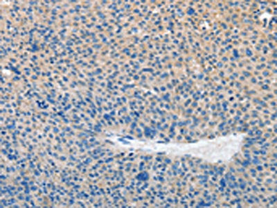 The image on the left is immunohistochemistry of paraffin-embedded Human liver cancer tissue using the antibody Antibody) at dilution 1/20, on the right is treated with synthetic peptide. (Original magnification: ×200)Rabbit anti-Human PRKG2 Polyclonal Antibody