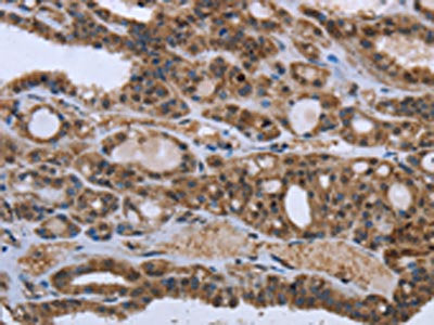 The image on the left is immunohistochemistry of paraffin-embedded Human thyroid cancer tissue using GGCX Antibody(GGCX Antibody) at dilution 1/50, on the right is treated with fusion protein. (Original magnification: ×200)Rabbit anti-Human GGCX Polyclonal Antibody
