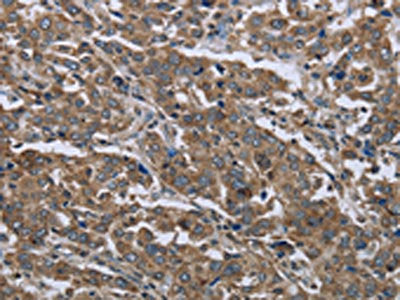 The image on the left is immunohistochemistry of paraffin-embedded Human liver cancer tissue using the antibody Antibody) at dilution 1/50, on the right is treated with fusion protein. (Original magnification: ×200)Rabbit anti-Human GGCX Polyclonal Antibody