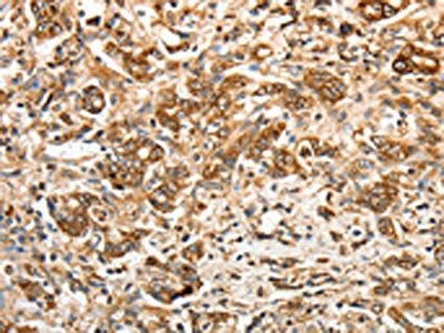 The image on the left is immunohistochemistry of paraffin-embedded Human gastric cancer tissue using CALR Antibody(CALR Antibody) at dilution 1/30, on the right is treated with fusion protein. (Original magnification: ×200)