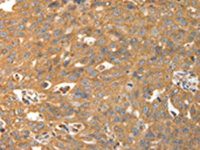 The image on the left is immunohistochemistry of paraffin-embedded Human ovarian cancer tissue using the antibody Antibody) at dilution 1/30, on the right is treated with fusion protein. (Original magnification: ×200)