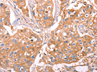 The image on the left is immunohistochemistry of paraffin-embedded Human breast cancer tissue using GC Antibody(GC Antibody) at dilution 1/40, on the right is treated with fusion protein. (Original magnification: ×200)Rabbit anti-Human GC Polyclonal Antibody