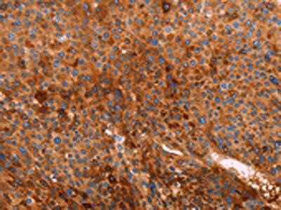 The image on the left is immunohistochemistry of paraffin-embedded Human liver cancer tissue using the antibody Antibody) at dilution 1/40, on the right is treated with fusion protein. (Original magnification: ×200)Rabbit anti-Human GC Polyclonal Antibody