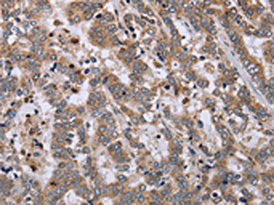 The image on the left is immunohistochemistry of paraffin-embedded Human liver cancer tissue using the antibody Antibody) at dilution 1/40, on the right is treated with fusion protein. (Original magnification: ×200)Rabbit anti-Human EPSTI1 Polyclonal Antibody