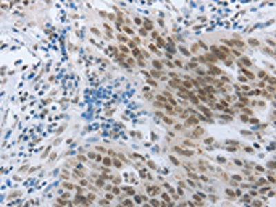 The image on the left is immunohistochemistry of paraffin-embedded Human ovarian cancer tissue using the antibody Antibody) at dilution 1/30, on the right is treated with synthetic peptide. (Original magnification: ×200)