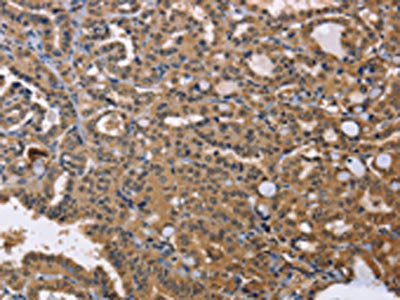 The image on the left is immunohistochemistry of paraffin-embedded Human thyroid cancer tissue using IDH1 Antibody(IDH1 Antibody) at dilution 1/25, on the right is treated with fusion protein. (Original magnification: ×200)Rabbit anti-Human IDH1 Polyclonal Antibody