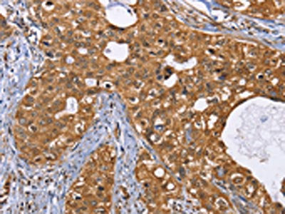 The image on the left is immunohistochemistry of paraffin-embedded Human cervical cancer tissue using the antibody Antibody) at dilution 1/25, on the right is treated with fusion protein. (Original magnification: ×200)Rabbit anti-Human IDH1 Polyclonal Antibody