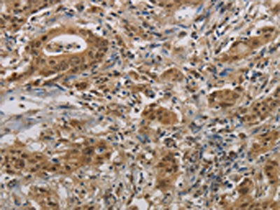 The image is immunohistochemistry of paraffin-embedded Human gastric cancer tissue using GAS7 Antibody(GAS7 Antibody) at dilution 1/30. (Original magnification: ×200)Rabbit anti-Human GAS7 Polyclonal Antibody