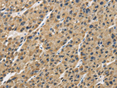 The image is immunohistochemistry of paraffin-embedded Human liver cancer tissue using the antibody Antibody) at dilution 1/30. (Original magnification: ×200)Rabbit anti-Human GAS7 Polyclonal Antibody