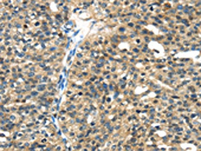 The image on the left is immunohistochemistry of paraffin-embedded Human breast cancer tissue using TGM5 Antibody(TGM5 Antibody) at dilution 1/30, on the right is treated with fusion protein. (Original magnification: ×200)