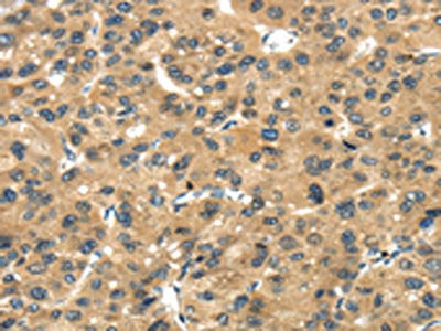 The image on the left is immunohistochemistry of paraffin-embedded Human liver cancer tissue using the antibody Antibody) at dilution 1/30, on the right is treated with fusion protein. (Original magnification: ×200)