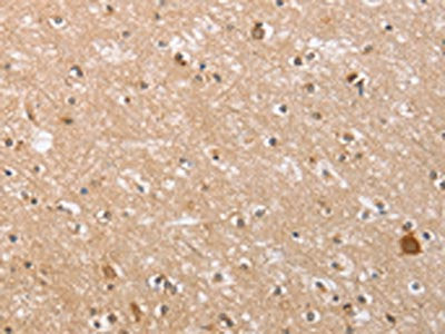 The image on the left is immunohistochemistry of paraffin-embedded Human brain  tissue using CTAGE5 Antibody(CTAGE5 Antibody) at dilution 1/40, on the right is treated with fusion protein. (Original magnification: ×200)Rabbit anti-Human CTAGE5 Polyclonal Antibody