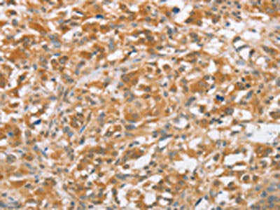 The image on the left is immunohistochemistry of paraffin-embedded Human thyroid cancer tissue using the antibody Antibody) at dilution 1/40, on the right is treated with fusion protein. (Original magnification: ×200)Rabbit anti-Human CTAGE5 Polyclonal Antibody