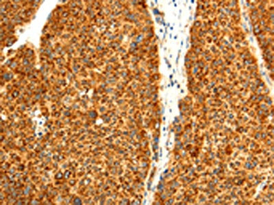 The image on the left is immunohistochemistry of paraffin-embedded Human liver cancer tissue using DIABLO Antibody(DIABLO Antibody) at dilution 1/50, on the right is treated with fusion protein. (Original magnification: ×200)Rabbit anti-Human DIABLO Polyclonal Antibody