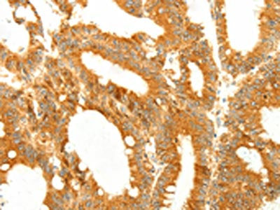 The image on the left is immunohistochemistry of paraffin-embedded Human colon cancer tissue using the antibody Antibody) at dilution 1/50, on the right is treated with fusion protein. (Original magnification: ×200)Rabbit anti-Human DIABLO Polyclonal Antibody