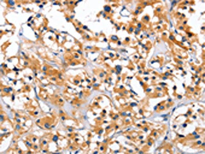 The image on the left is immunohistochemistry of paraffin-embedded Human thyroid cancer tissue using CEP97 Antibody(CEP97 Antibody) at dilution 1/40, on the right is treated with fusion protein. (Original magnification: ×200)Rabbit anti-Human CEP97 Polyclonal Antibody