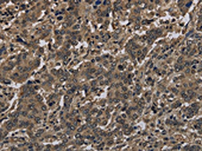 The image on the left is immunohistochemistry of paraffin-embedded Human liver cancer tissue using HIST1H4A Antibody(HIST4H4 Antibody) at dilution 1/30, on the right is treated with fusion protein. (Original magnification: ×200)Rabbit anti-Human HIST1H4A Polyclonal Antibody