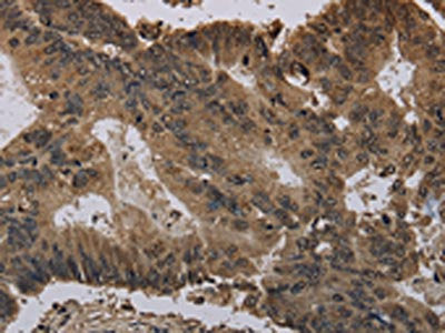 The image on the left is immunohistochemistry of paraffin-embedded Human colon cancer tissue using the antibody Antibody) at dilution 1/30, on the right is treated with fusion protein. (Original magnification: ×200)Rabbit anti-Human HIST1H4A Polyclonal Antibody