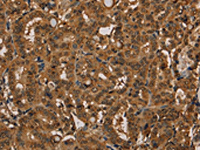 The image on the left is immunohistochemistry of paraffin-embedded Human thyroid cancer tissue using KIF20A Antibody(KIF20A Antibody) at dilution 1/20, on the right is treated with fusion protein. (Original magnification: ×200)