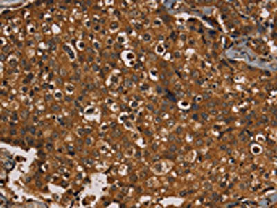 The image on the left is immunohistochemistry of paraffin-embedded Human breast cancer tissue using the antibody Antibody) at dilution 1/20, on the right is treated with fusion protein. (Original magnification: ×200)
