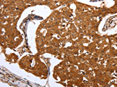 The image on the left is immunohistochemistry of paraffin-embedded Human breast cancer tissue using PARP1 Antibody(PARP1 Antibody) at dilution 1/20, on the right is treated with synthetic peptide. (Original magnification: ×200)Rabbit anti-Human PARP1 Polyclonal Antibody