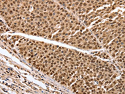 The image on the left is immunohistochemistry of paraffin-embedded Human liver cancer tissue using the antibody Antibody) at dilution 1/20, on the right is treated with synthetic peptide. (Original magnification: ×200)Rabbit anti-Human PARP1 Polyclonal Antibody