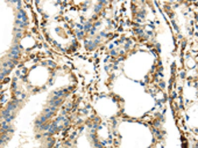 The image on the left is immunohistochemistry of paraffin-embedded Human thyroid cancer tissue using IQGAP2 Antibody(IQGAP2 Antibody) at dilution 1/45, on the right is treated with synthetic peptide. (Original magnification: ×200)