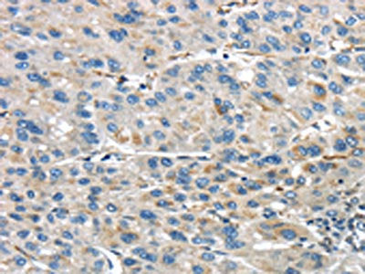 The image on the left is immunohistochemistry of paraffin-embedded Human liver cancer tissue using the antibody Antibody) at dilution 1/45, on the right is treated with synthetic peptide. (Original magnification: ×200)