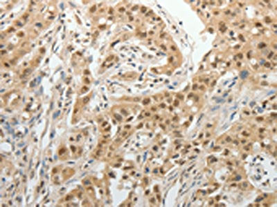 The image on the left is immunohistochemistry of paraffin-embedded Human lung cancer tissue using PSMD14 Antibody(PSMD14 Antibody) at dilution 1/25, on the right is treated with fusion protein. (Original magnification: ×200)Rabbit anti-Human PSMD14 Polyclonal Antibody