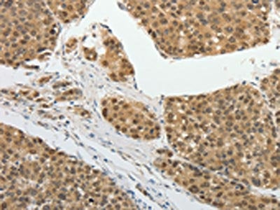 The image on the left is immunohistochemistry of paraffin-embedded Human liver cancer tissue using the antibody Antibody) at dilution 1/25, on the right is treated with fusion protein. (Original magnification: ×200)Rabbit anti-Human PSMD14 Polyclonal Antibody
