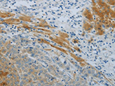 The image on the left is immunohistochemistry of paraffin-embedded Human liver cancer tissue using NPHS1 Antibody(NPHS1 Antibody) at dilution 1/40, on the right is treated with synthetic peptide. (Original magnification: ×200)Rabbit anti-Human NPHS1 Polyclonal Antibody