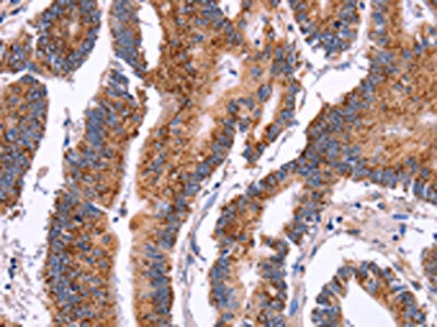 The image on the left is immunohistochemistry of paraffin-embedded Human colon cancer tissue using CROT Antibody(CROT Antibody) at dilution 1/50, on the right is treated with fusion protein. (Original magnification: ×200)Rabbit anti-Human CROT Polyclonal Antibody