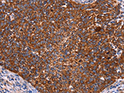 The image on the left is immunohistochemistry of paraffin-embedded Human cervical cancer tissue using the antibody Antibody) at dilution 1/50, on the right is treated with fusion protein. (Original magnification: ×200)Rabbit anti-Human CROT Polyclonal Antibody