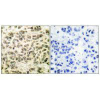 Immunohistochemical analysis of paraffin-embedded human breast carcinoma tissue using HDAC3 antibody.Rabbit anti-Human HDAC3 Polyclonal Antibody