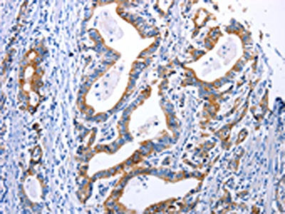 The image on the left is immunohistochemistry of paraffin-embedded Human gastric cancer tissue using DRD4 Antibody(DRD4 Antibody) at dilution 1/30, on the right is treated with synthetic peptide. (Original magnification: ×200)Rabbit anti-Human DRD4 Polyclonal Antibody