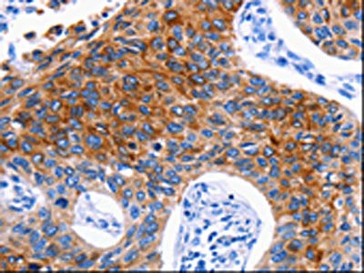 The image on the left is immunohistochemistry of paraffin-embedded Human lung cancer tissue using the antibody Antibody) at dilution 1/30, on the right is treated with synthetic peptide. (Original magnification: ×200)Rabbit anti-Human DRD4 Polyclonal Antibody