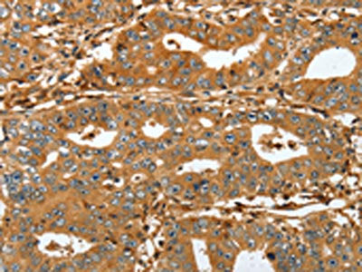 The image on the left is immunohistochemistry of paraffin-embedded Human gastric cancer tissue using the antibody Antibody) at dilution 1/45, on the right is treated with fusion protein. (Original magnification: ×200)Rabbit anti-Human RAP1A Polyclonal Antibody