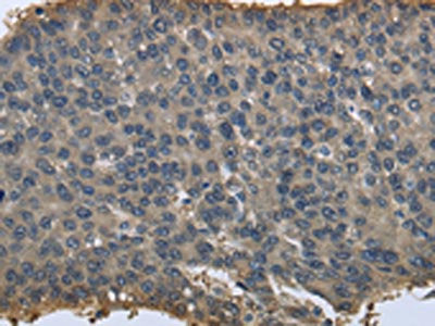 The image on the left is immunohistochemistry of paraffin-embedded Human liver cancer tissue using PRDX6 Antibody(PRDX6 Antibody) at dilution 1/25, on the right is treated with fusion protein. (Original magnification: ×200)Rabbit anti-Human PRDX6 Polyclonal Antibody