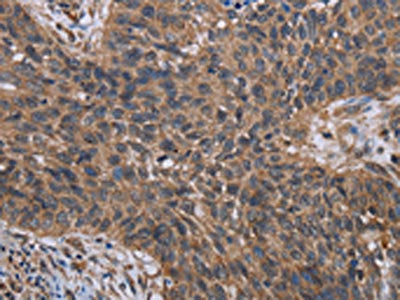 The image on the left is immunohistochemistry of paraffin-embedded Human lung cancer tissue using HIF1A Antibody(HIF1A Antibody) at dilution 1/40, on the right is treated with fusion protein. (Original magnification: ×200)Rabbit anti-Human HIF1A Polyclonal Antibody