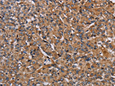 The image on the left is immunohistochemistry of paraffin-embedded Human prostate cancer tissue using the antibody Antibody) at dilution 1/40, on the right is treated with fusion protein. (Original magnification: ×200)Rabbit anti-Human HIF1A Polyclonal Antibody